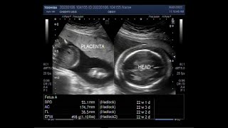 Hydrops fetalis with Fetal Soft tissue edema Ascites and Pleural effusion [upl. by Neelyar]