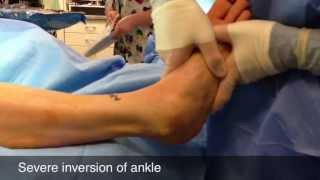 Surgery for Sprained Ankle [upl. by Aiuhsoj]