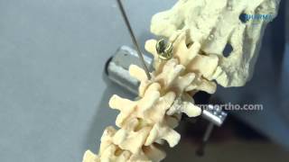 Pedicle Screw Fixation CORE Spinal System [upl. by Uyr895]