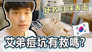 【韓國醫美】痘疤痘坑有救嗎？帶我弟來韓國醫美治月球表面！ Erin愛漂亮系列 [upl. by Keel682]