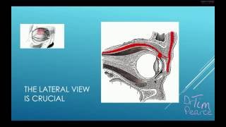 Eyelid Ptosis From Botulinum Toxins  Understanding The Crucial Anatomy [upl. by Gnay]