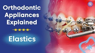 Orthodontic Appliances Explained  Elastics [upl. by Nigel97]