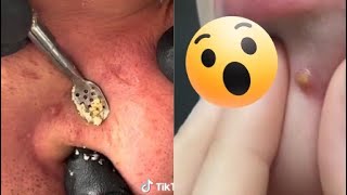 Ultimate Pimple Popping Compilation 2024  Satisfying Blackhead amp Acne Removal  Oddly Satisfying [upl. by Ellenrahc387]