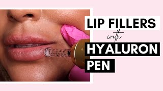 No Needle Lip Filler With Hyaluron Pen  Procedure And Aftercare Ft SaigeWellington [upl. by Anahsohs]