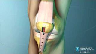 Anterior Cruciate Ligament ACL Reconstruction Animation [upl. by Walker]