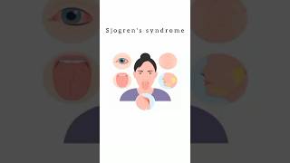 Sjogren’s Syndrome kattrucate medicalreels sjogren syndrome triads arthritis shorts [upl. by Alyekahs211]