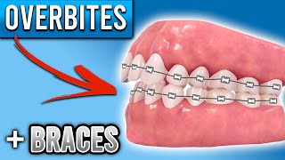 How Do BRACES FIX Overbites  Overbite Before and After Braces  Premier Orthodontics [upl. by Brag]