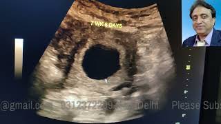 Ultrasound 8 weeks Normal cyst of Rhombencephalon Cord Development Limb buds Yolk sac [upl. by Ayojal863]