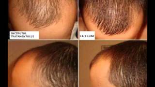 Tratament Păr  Scapă de chelie calviție alopecie Kirkland Minoxidil 5wmv [upl. by Tunk]