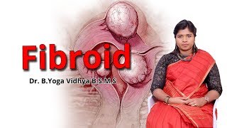 ஃபைப்ராய்டு கட்டிகளுக்கு சிகிச்சை  Fibroid Uterus Treatment  Dr BYoga Vidhya [upl. by Lettig426]