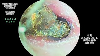 采耳哥Ear wax removingsatisfying video for ear Fungus cleaning  502 [upl. by Valentina]