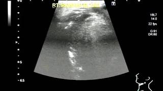 Ultrasound Video showing a small and illdefined mass in Parotid gland A rare case [upl. by Liew]