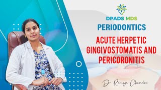 Acute Herpetic Gingivostomatitis and Pericoronitis  Periodontics  Dr Ramya Chandra  DPADS MDS [upl. by Madeleine]