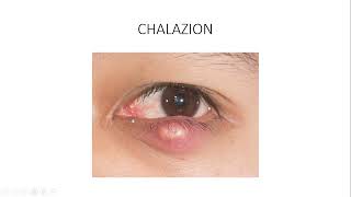 OBENG SERIES  CHALAZION AND HORDEOLUM [upl. by Watkins]