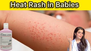 Garmi dano ka Ilaj  prickly heat Treatment at home  heat rash solution [upl. by Bates]