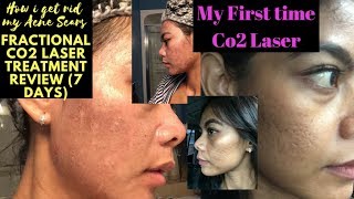 Acne Scars Removal First time Co2 laser treatment 7 Days Review [upl. by Einnil156]