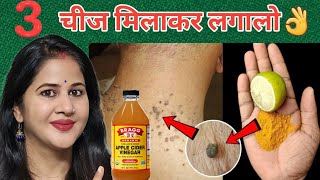 तिल और मस्से को जड़ से खत्म करने का सबसे अच्छा उपायRemove Skin Tag Naturally👌 [upl. by Adyol]