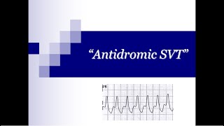 ECG Tip 21 What about quotAntidromicquot SVT [upl. by Welker]