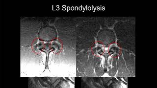 MRI of the Lumbar Spine  Part 9  Lumbar Trauma [upl. by Terb]