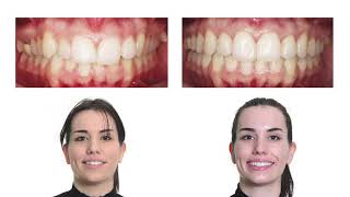 Caso real con ortodoncia Invisalign  Antesdespués [upl. by Indnahc437]