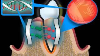 The term Periodontosis is not a correct medical term [upl. by Koralle620]