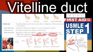 Vitelline duct  Patent vitelline duct Vitelline duct cyst Mackel diverticulum in HindiUrdu [upl. by Nnaytsirk]