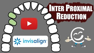 Inter Proximal Reduction IPR For Invisalign Treatments [upl. by Annirtak580]