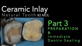 Lithium Disilicate Ceramics Part 3 Preparation and Immediate Dentin Sealing IDS [upl. by Erodasi]