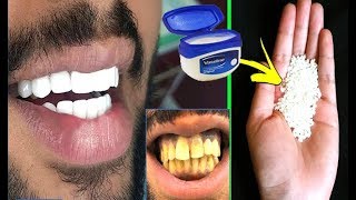 In Just 2 Minutes Turn Yellow Teeth To Pearl White and Shine Teeth Whiten at Home everyday culture [upl. by Kokaras152]