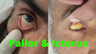 PALLOR and ICTERUS in EYE  ANEMIA and JAUNDICE in eye examination [upl. by Ahsai950]