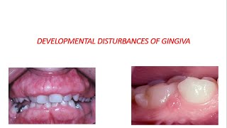 DEVELOPMENTAL DISTURBANCES OF GINGIVA [upl. by Kcirderfla]