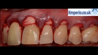 Alloderm Periodontal Surgery for Gum RecessionGraftingRoot CoverageUpper Teeth [upl. by Mina]