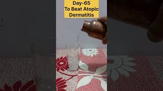 Day65 To Beat Atopic Dermatitis✅️ [upl. by Nyra]