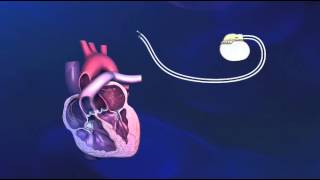 Implantatie van een tweekamerpacemaker  Medtronic [upl. by Eneloc]