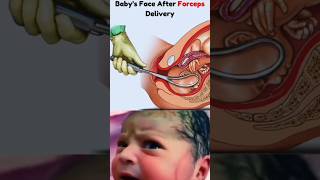 Baby After Birth Forceps Delivery shorts viral baby ytshorts birth youtubeshorts [upl. by Sharline627]