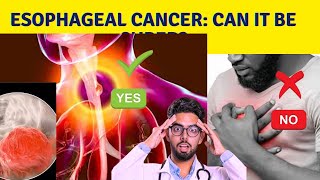 What is the survival rate for esophageal cancer [upl. by Anaujahs748]