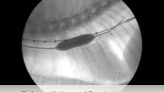 Veterinary Bronchoscopy545 Tracheal Stent Placement for Tracheal Obstruction in a cat [upl. by Asseram]