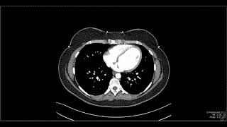 Abdominal Anatomy on Computed Tomography [upl. by Ohara603]