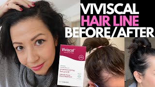 YES VIVISCAL SUPPLEMENTS WORKED Hair Loss Sufferers 3 Month Hair Regrowth Experience BEFOREAFTER [upl. by Silvana]