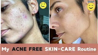 How I Got RID OF ACNE With Lifestyle Changes and CBD [upl. by Wylie130]