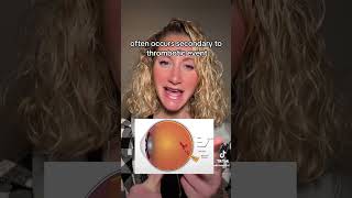 Retinal Vein Occlusion Review physicianassistant medicine retina ophthalmology fypシ fyp [upl. by Anem432]