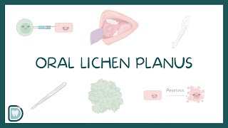 Oral Lichen Planus Causes Diagnosis Types and Management [upl. by Mariam397]