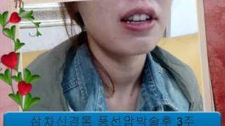 삼차신경통 풍선압박술 trigeminal neuralgia and balloon compression of trigeminal ganglion [upl. by Hametaf]