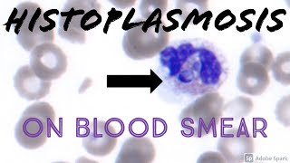 Intracellular YeastFungus on Peripheral Blood Smear Histoplasmosis Hematology Microbiology [upl. by Ullyot]