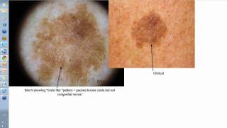 Dermoscopy Made Simple  Seborrhoeic Keratoses [upl. by Nilats347]