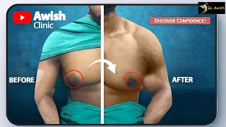 quotMale Chest Surgeryquot  quotGynecomastia Surgery Before and After Transformationsquot AWISH Clinic [upl. by Yllop]