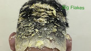 DRY SCALP  Big Flakes Dandruff Scratching Satisfying Video 768 [upl. by Dulcea147]