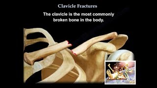 Clavicle Fractures  Everything You Need To Know  Dr Nabil Ebraheim [upl. by Anirac225]