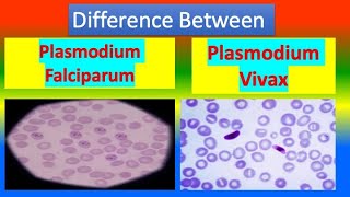 Distinction Between Plasmodium Falciparum and Plasmodium Vivax [upl. by Amle934]