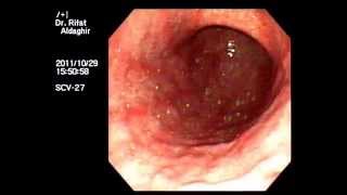 severe H pylori gastritis [upl. by Ferro]